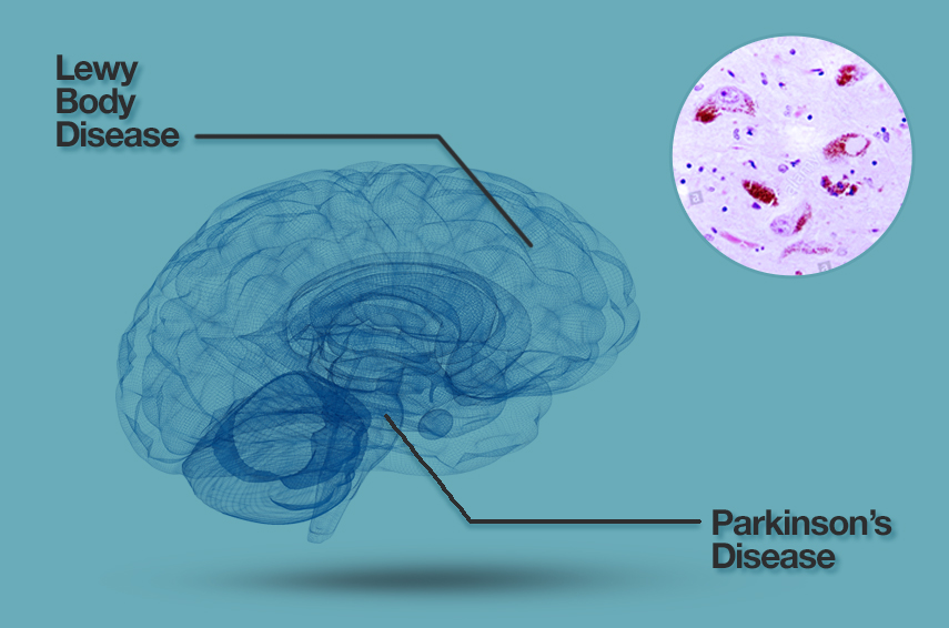 Lewy Body Dementia: Overview, Symptoms, Diagnosis, and Care