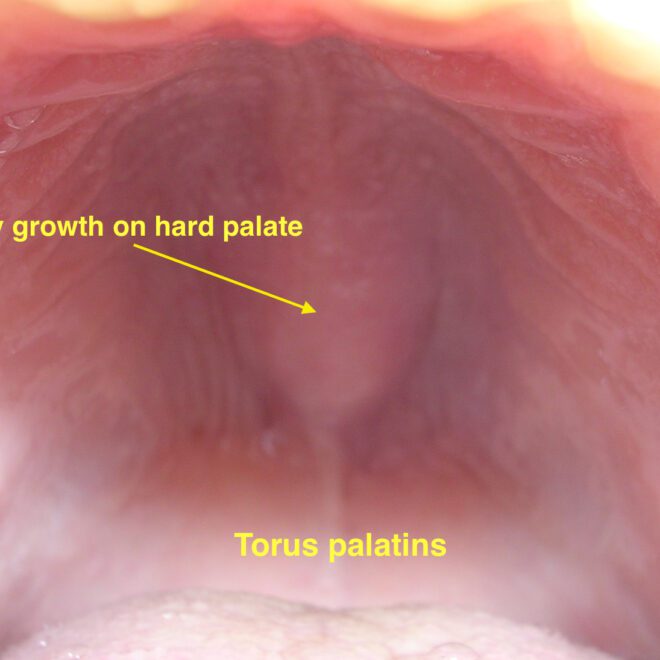 Leukoplakia: Causes, Symptoms, Diagnosis, and Treatment Options