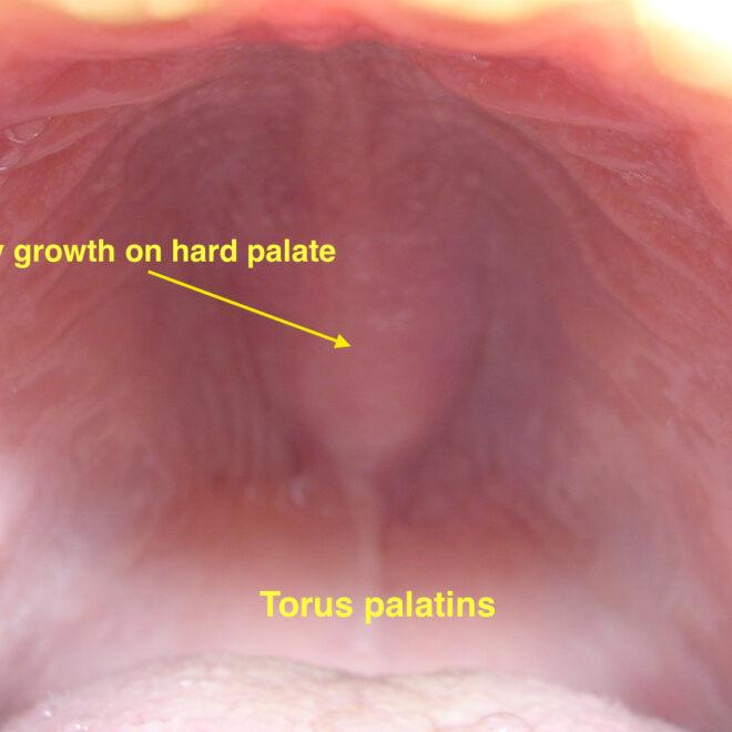 Burning Tongue Syndrome (Glossodynia): Overview, Causes, and Treatments
