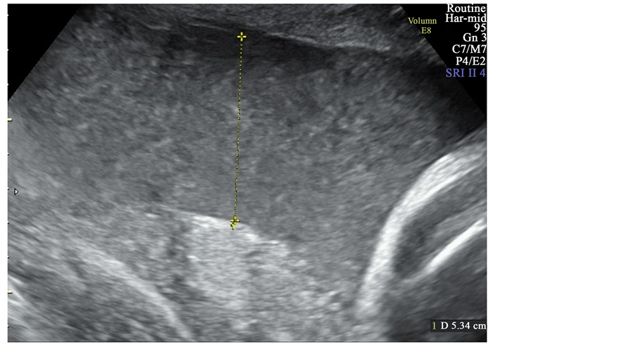 Excess Amniotic Fluid (Polyhydramnios): Causes, Symptoms, Diagnosis & Management
