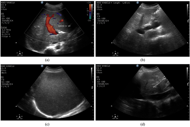Enlarged Spleen (Splenomegaly): Overview, Causes, Diagnosis & Care