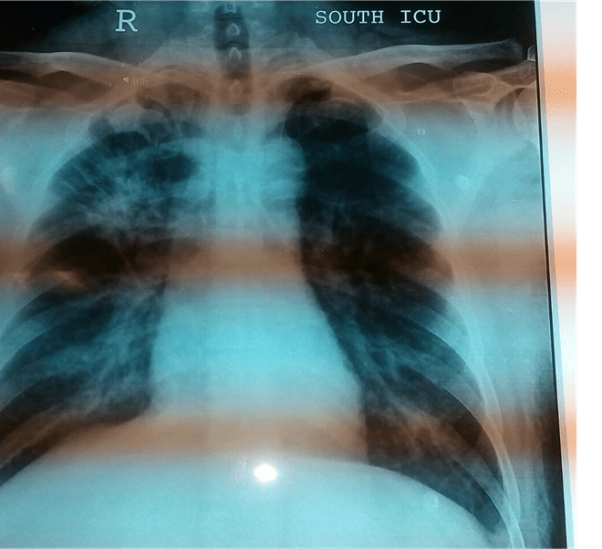 Leptospirosis: Causes, Symptoms, Diagnosis, and Treatment (Weil’s Disease)