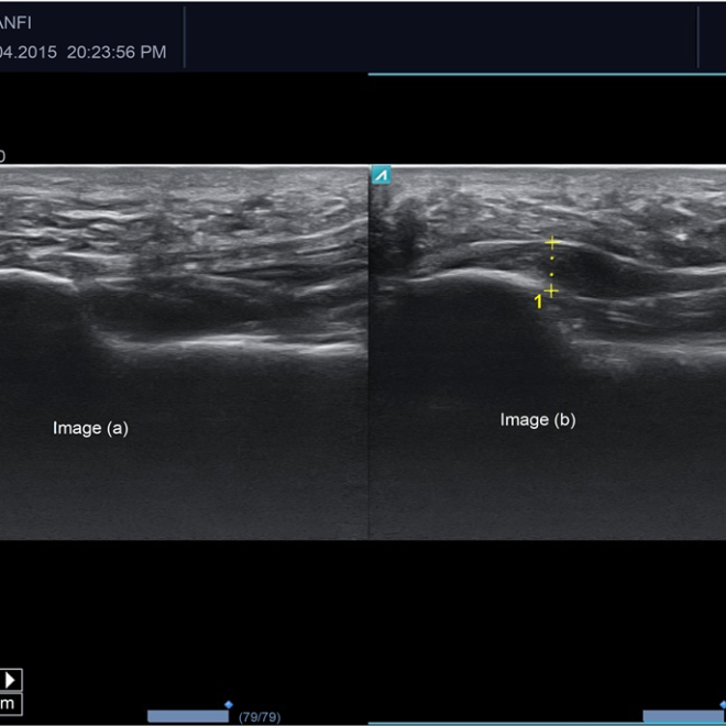 Plantar Fasciitis: Causes, Symptoms, and Treatments
