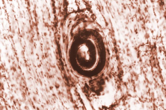 Trichinosis: Causes, Symptoms, Diagnosis, and Treatment (Roundworm Infection)