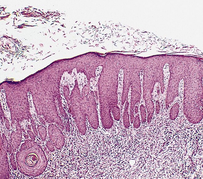 Acanthosis Nigricans: Causes, Symptoms, Diagnosis, and Treatment