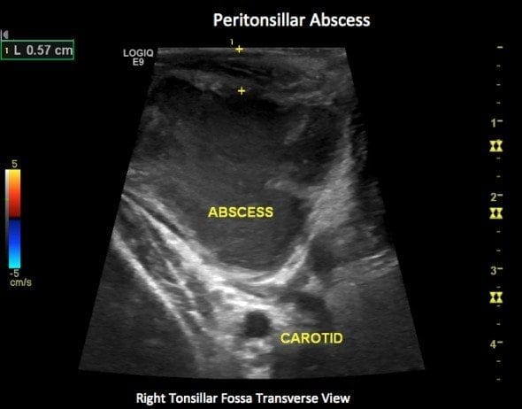 Peritonsillar Abscess: Causes, Symptoms, Diagnosis, and Treatment
