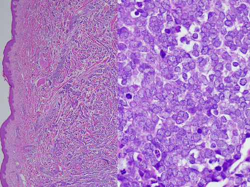 Merkel Cell Carcinoma (Rare Skin Cancer): Overview, Symptoms, Diagnosis & Treatment