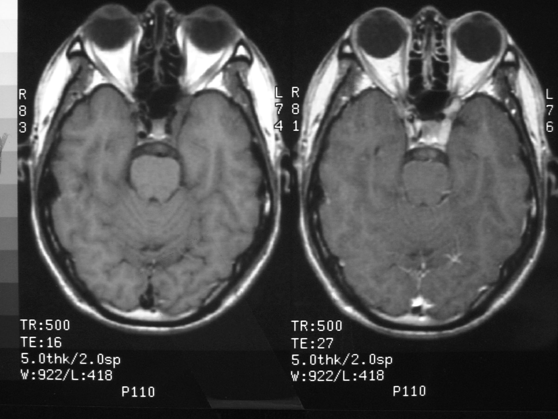 Ramsay Hunt Syndrome: Overview, Causes, Symptoms & Treatments