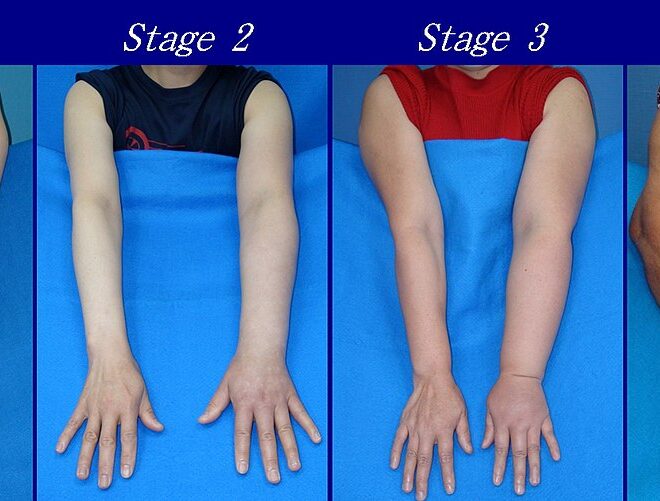 Swelling in the Body (Edema): Causes, Types, and Treatments