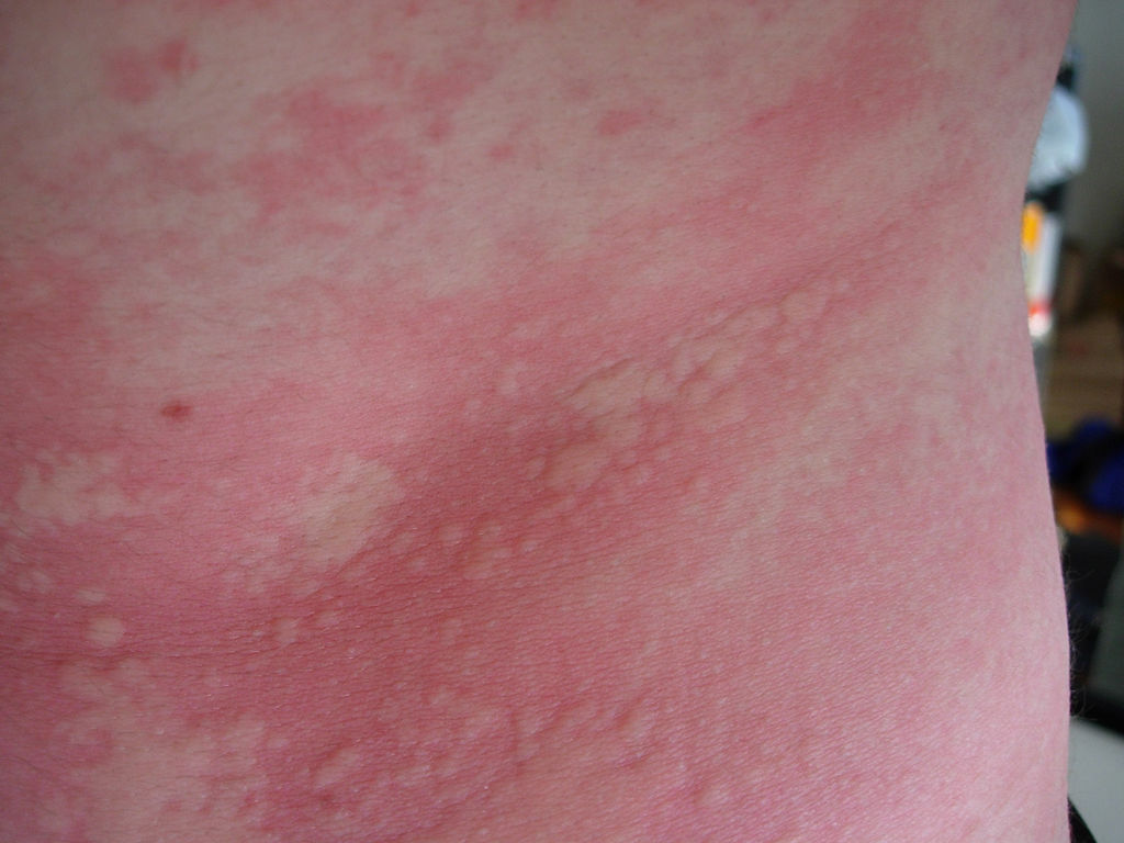 Hives: Causes, Symptoms, Types, and Treatments