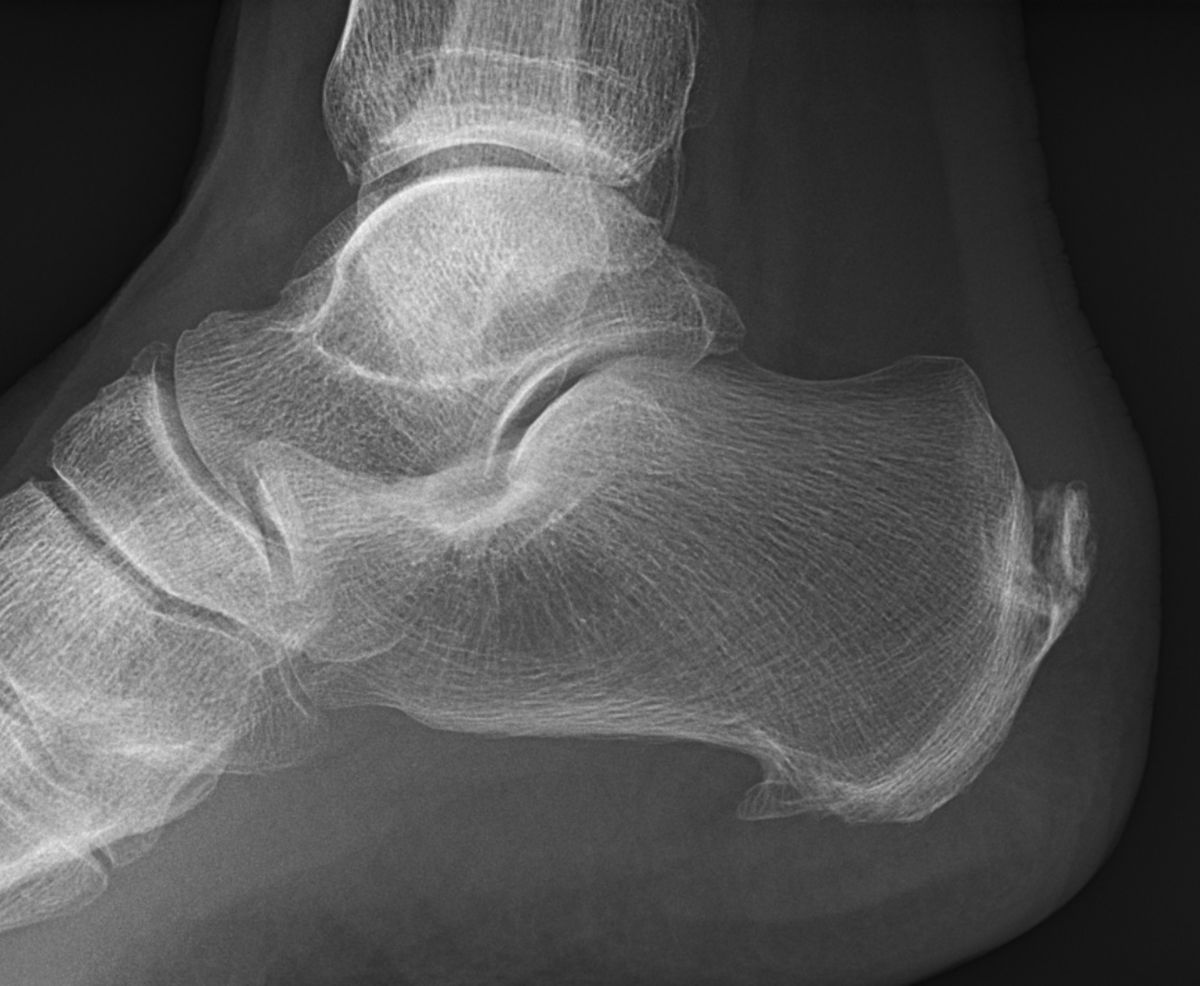 Heel Spurs (Calcaneal Spurs): Causes, Symptoms, and Treatments