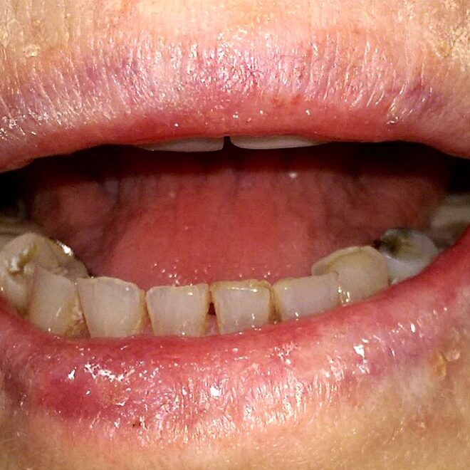 Cracked Corners of the Mouth (Angular Cheilitis): Causes, Symptoms, and Treatments
