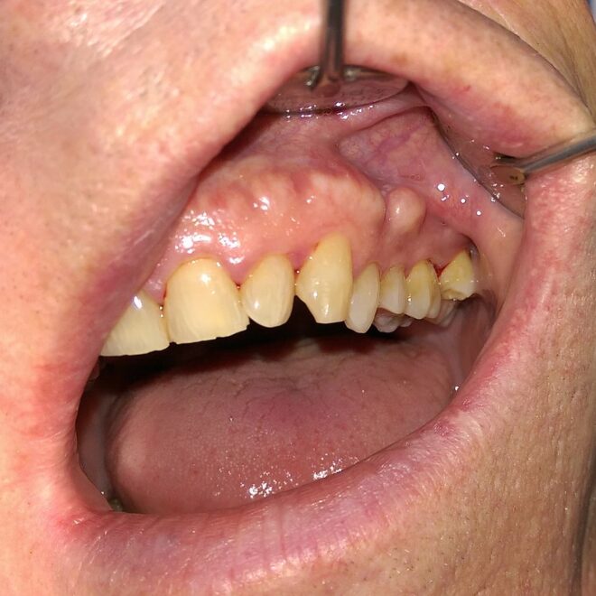 Bone Spurs: What They Are, Causes, Symptoms & Treatment