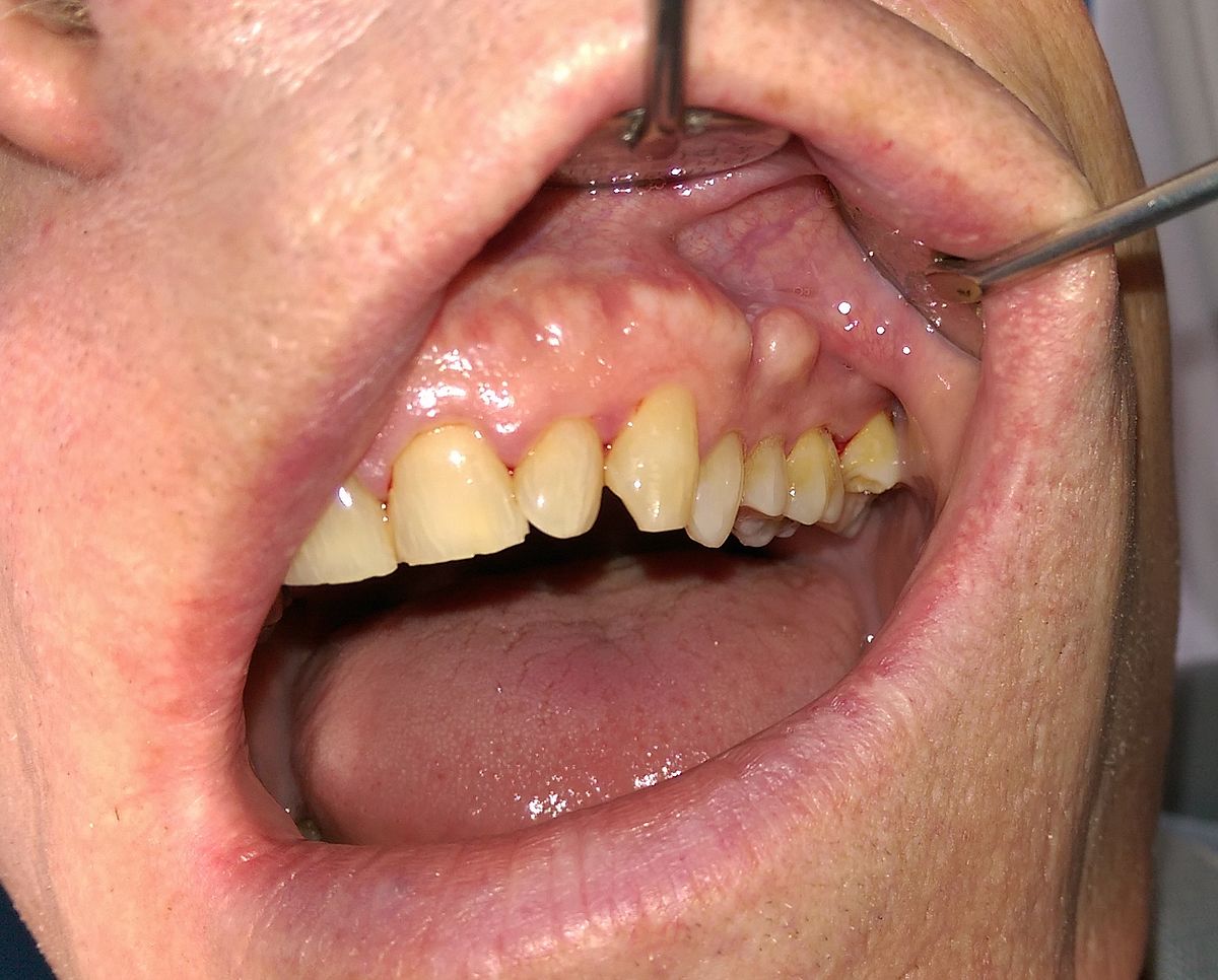 Oral Cancer: Understanding Causes, Symptoms, and Treatments