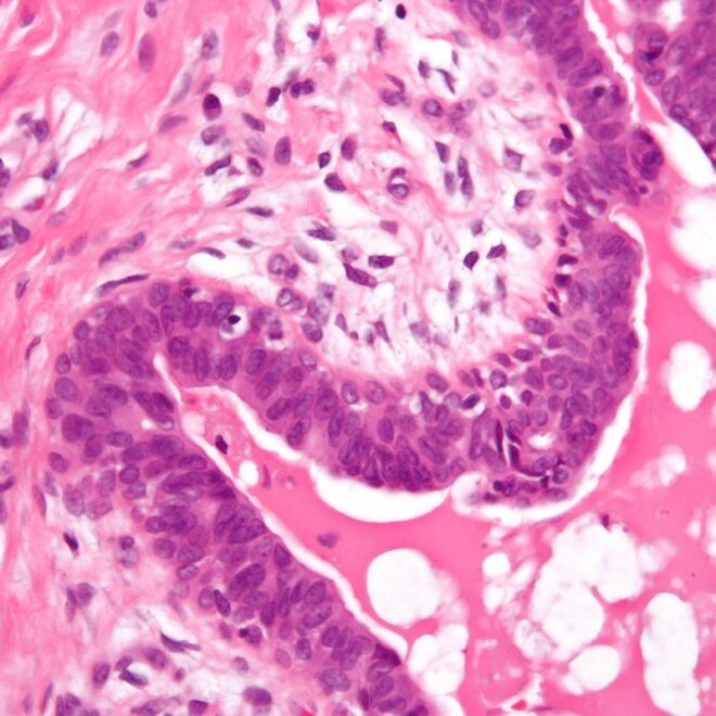 Enlarged Breast Tissue in Men (Gynecomastia): Causes, Symptoms & Treatments