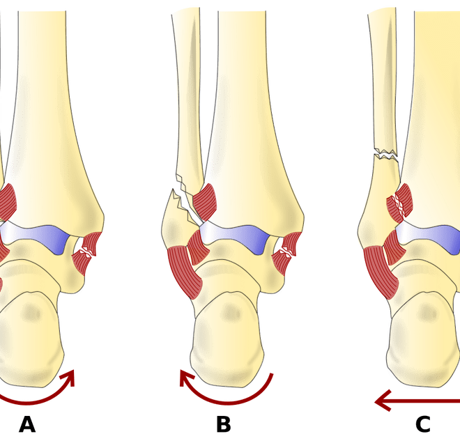 Ankle Fracture (Broken Ankle): Types, Symptoms, Diagnosis, and Treatment