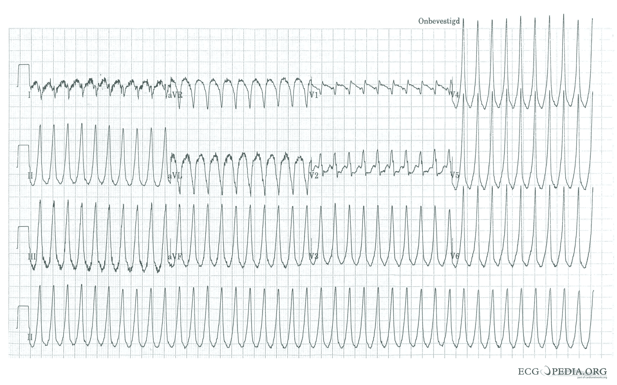 Fast Heart Rate (Tachycardia): Overview, Types, Causes & Treatments