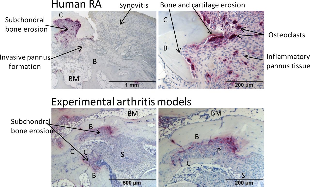 Juvenile Rheumatoid Arthritis (JRA): A Complete Guide