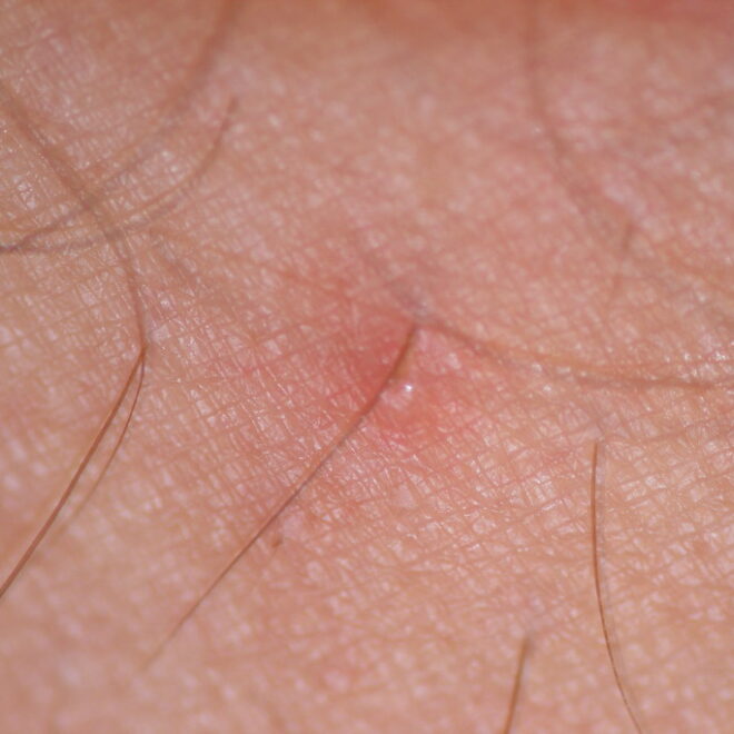 Chigger Bites: Symptoms, Causes, Treatment, and Prevention