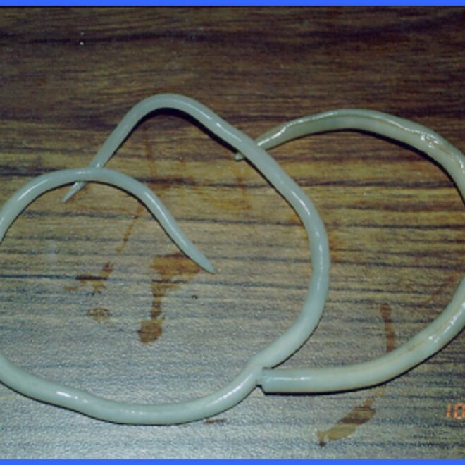 Roundworm Infection (Ascariasis): Causes, Symptoms, and Treatment