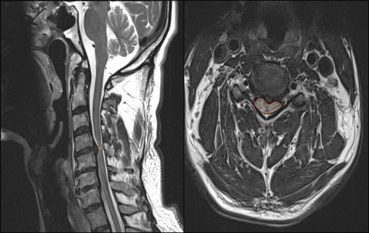Spinal Cord Compression (Myelopathy): Causes, Symptoms, and Treatments