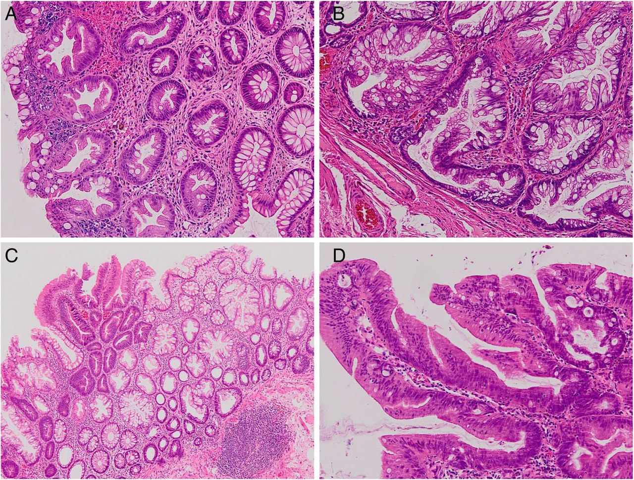 Colon Polyps: Types, Causes, Symptoms, and Removal