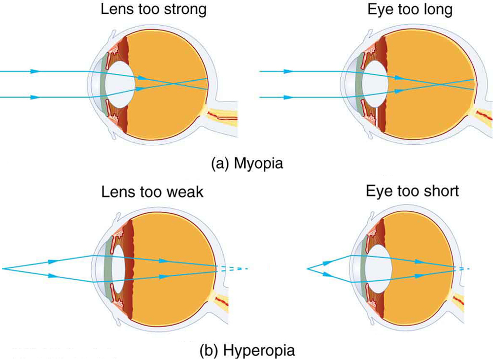 Farsightedness (Hyperopia): Causes, Symptoms, and Treatments