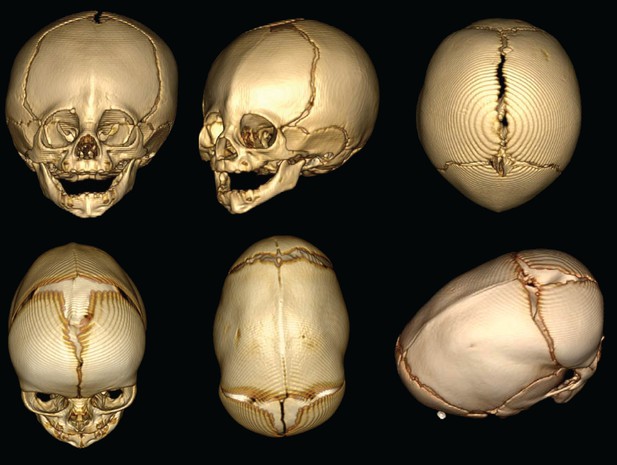 Craniosynostosis: A Detailed Overview of Premature Skull Fusion