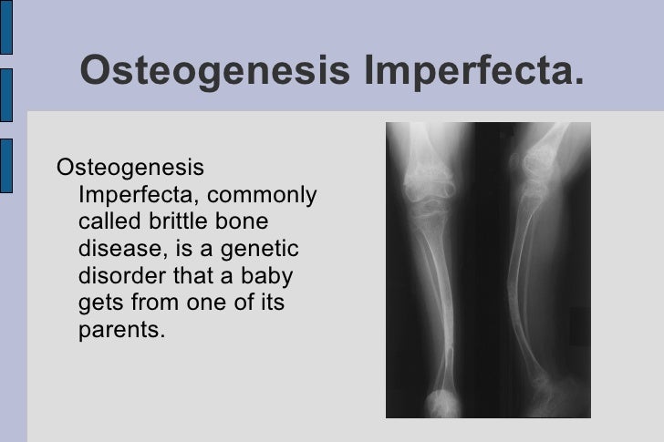 Osteogenesis Imperfecta: A Detailed Overview of Brittle Bone Disease