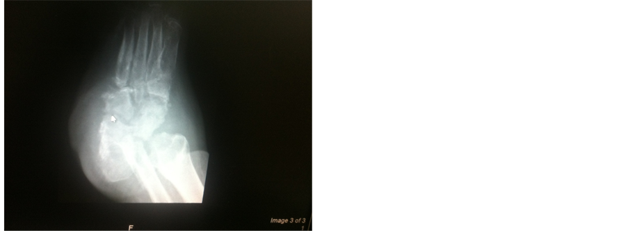 Charcot Foot (Neuropathic Arthropathy): Overview, Causes, and Management