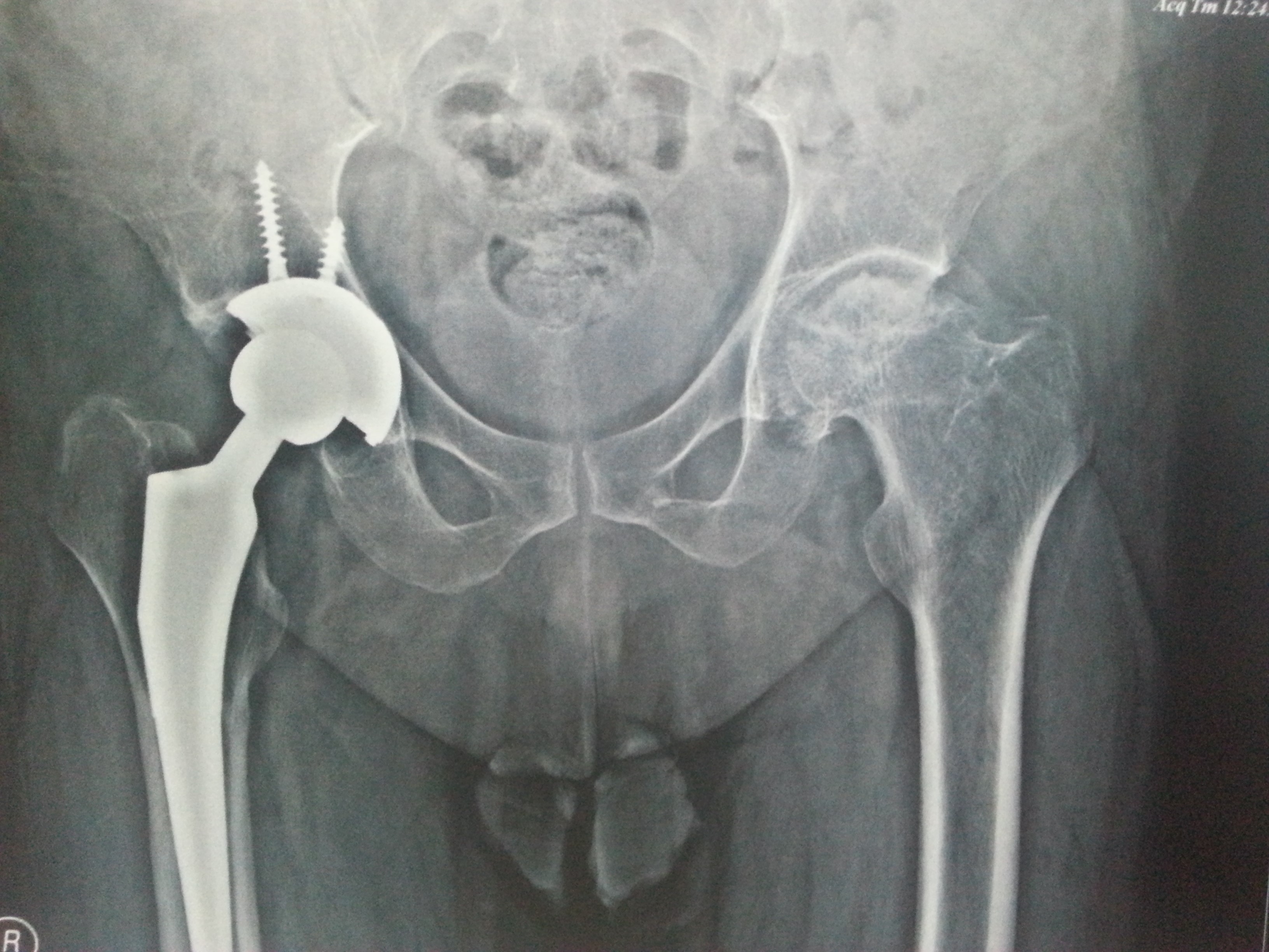 Hip Fracture: Causes, Symptoms, Diagnosis, and Treatment Options