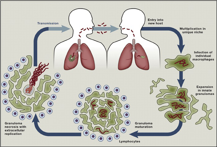 Tuberculosis: Causes, Symptoms, Diagnosis, and Treatment