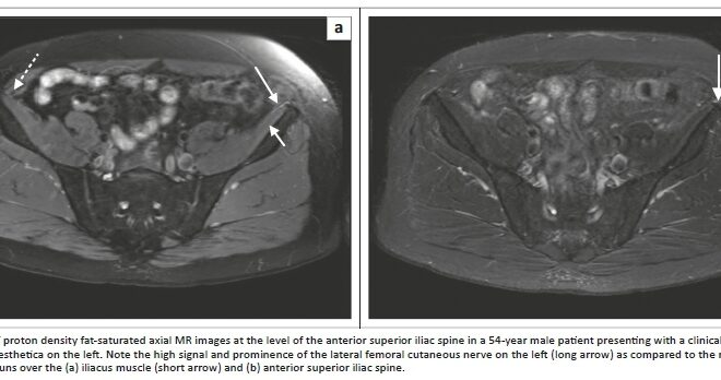 Meralgia Paresthetica: A Detailed Overview of Thigh Numbness and Pain (Lateral Femoral Cutaneous Neuropathy)