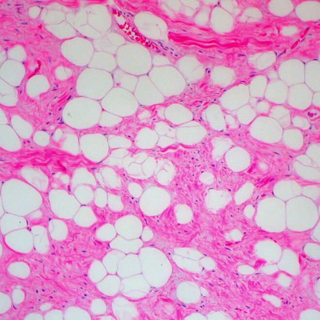 Lipoma: A Complete Guide to Fatty Lumps Under the Skin