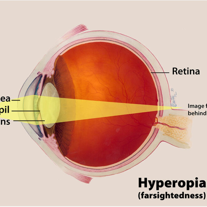 Farsightedness (Hyperopia): Causes, Symptoms, and Treatments