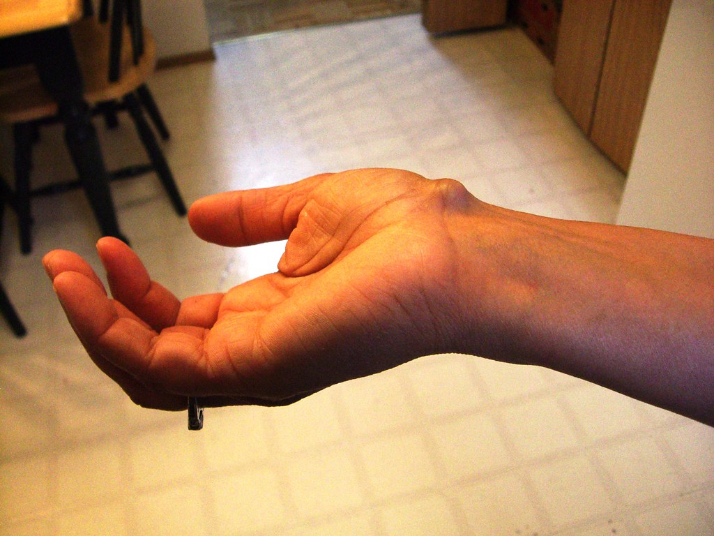 Ganglion Cyst: What It Is, Causes, Symptoms & Treatment