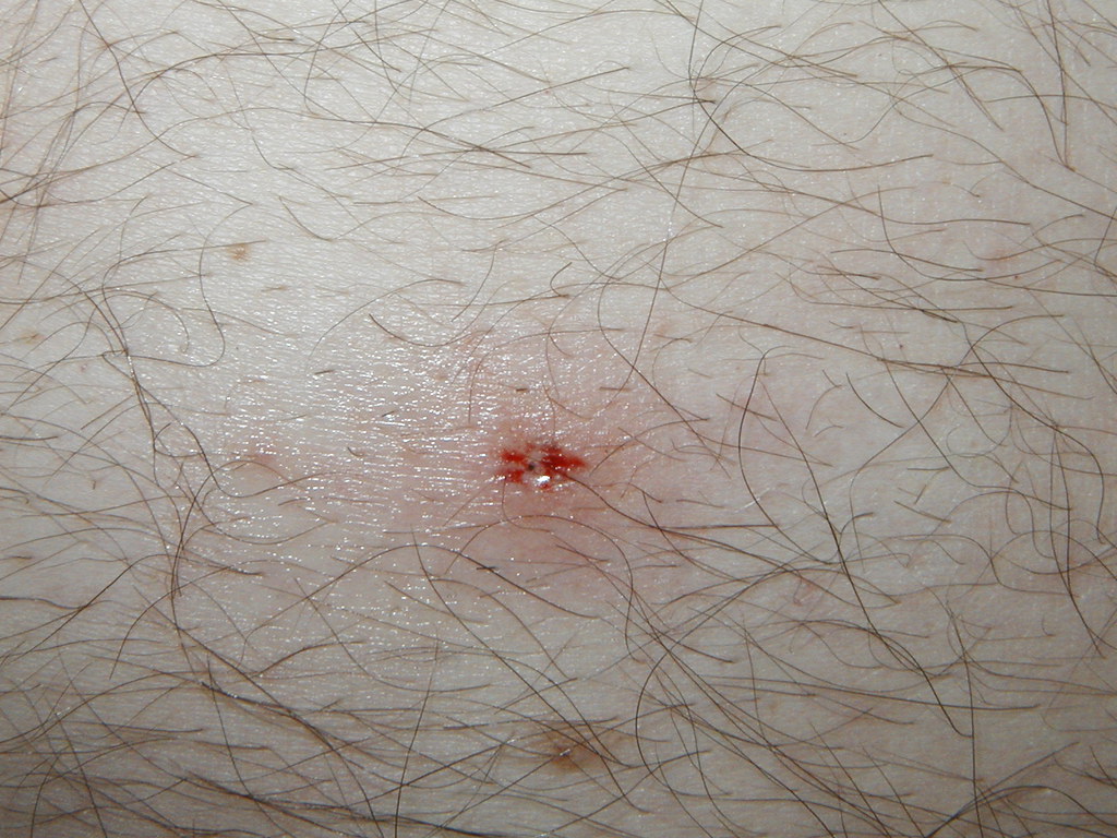 Tick Bites: Symptoms, Prevention, and Treatment Options