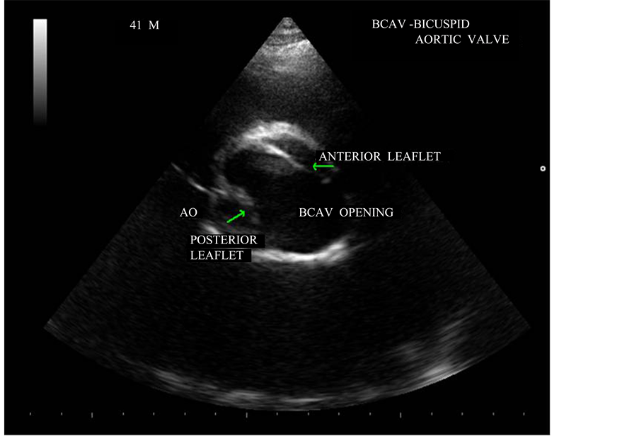 Rheumatic Heart Disease: Causes, Symptoms, and Care