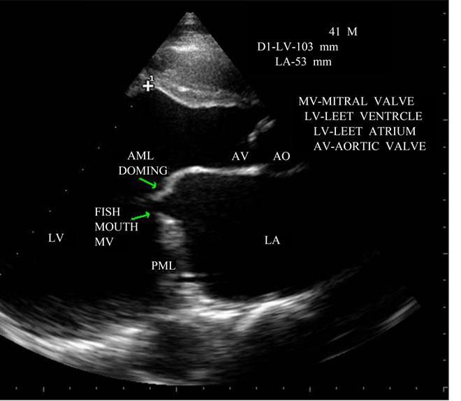 Mitral Valve Stenosis: Causes, Symptoms, Diagnosis, and Treatments