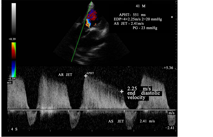 Mitral Valve Stenosis: Causes, Symptoms, Diagnosis, and Treatments