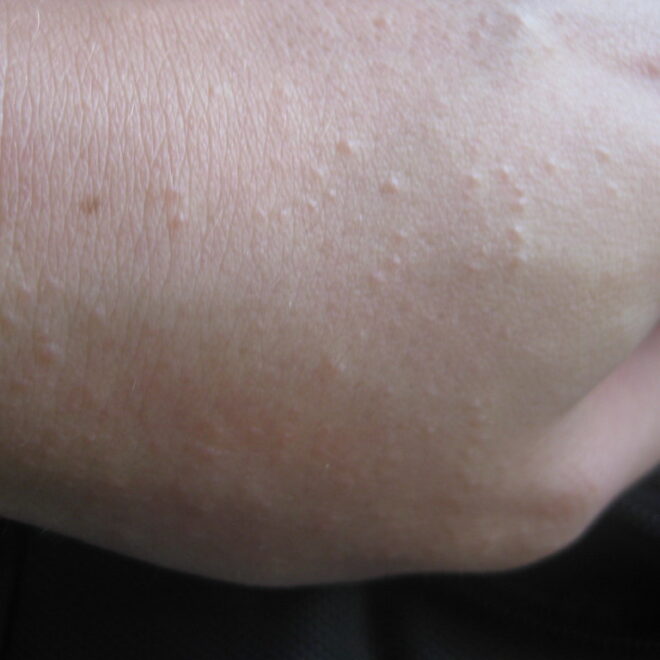Heat Rash: Causes, Symptoms, Prevention and Treatment