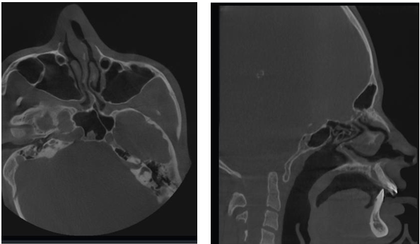 Treacher Collins Syndrome: A Detailed Overview of Facial Bone Development Disorder (TCS)
