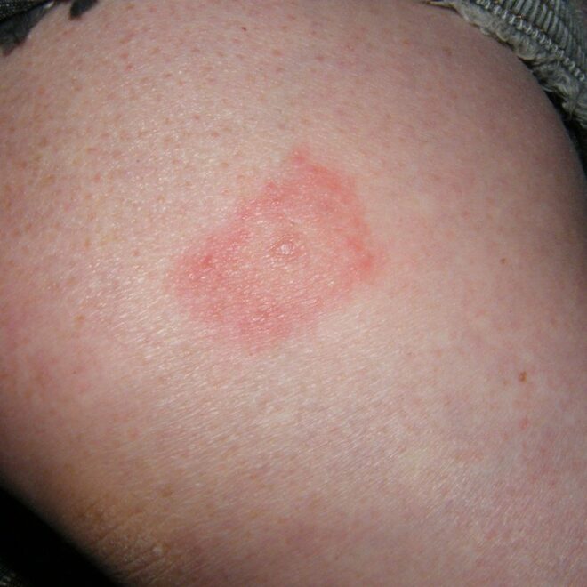 Tick Bites: Symptoms, Prevention, and Treatment Options