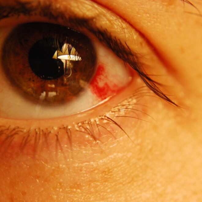 Subconjunctival Hemorrhage (Bleeding in the Eye): Causes, Symptoms & Care