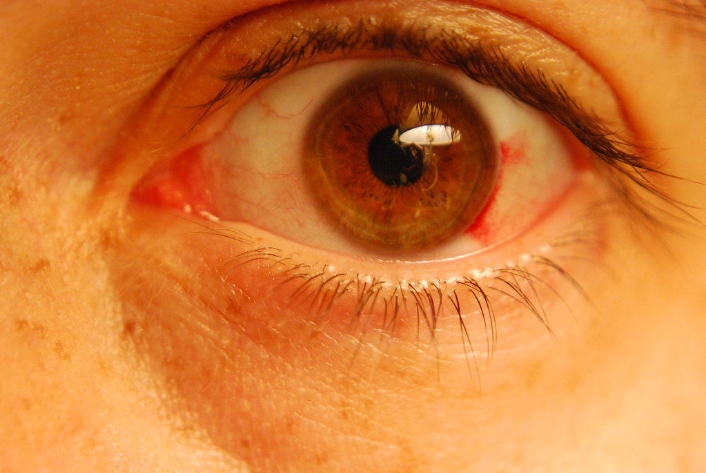Subconjunctival Hemorrhage (Bleeding in the Eye): Causes, Symptoms & Care