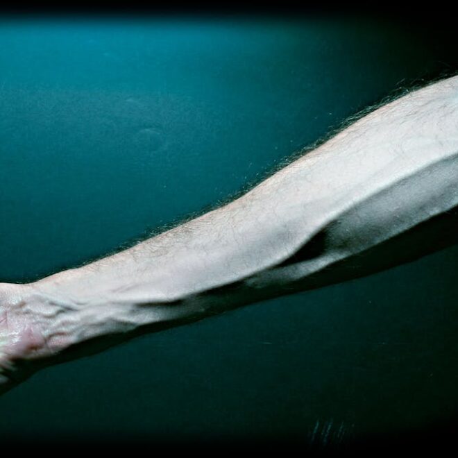 Varicose Veins: Causes, Symptoms, Diagnosis, and Treatments