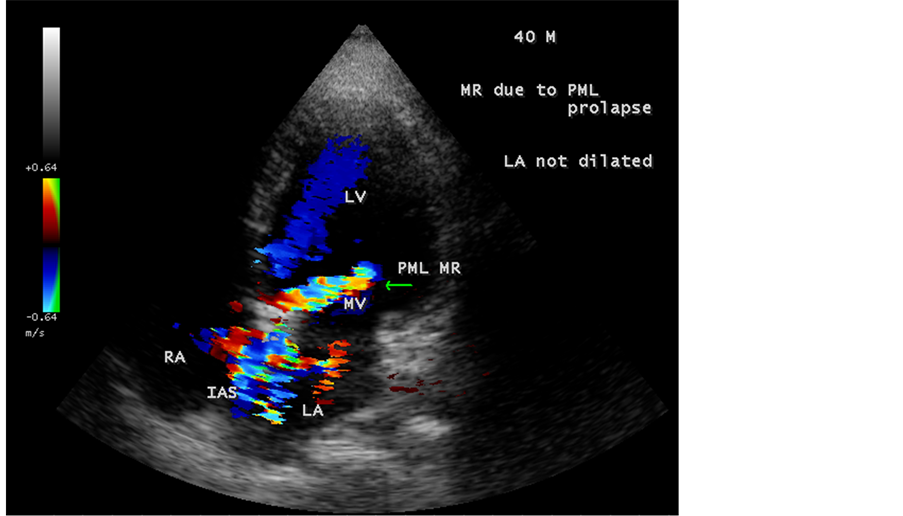 Mitral Valve Prolapse: Overview, Symptoms, Diagnosis & Care