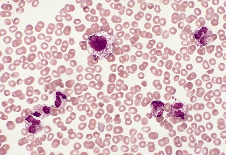 Hypereosinophilic Syndrome (HES): Causes, Symptoms, and Treatments