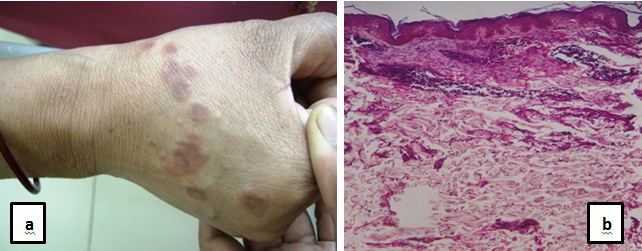 Granuloma Annulare: Causes, Symptoms, Diagnosis & Treatment
