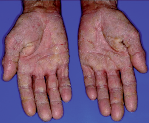 Eczema: Understanding the Skin Condition, Its Triggers, and Care Options